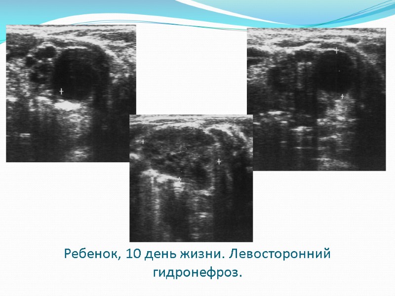 Ребенок, 10 день жизни. Левосторонний гидронефроз.